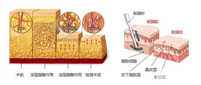 2019年腰部吸脂減肥價格一覽表 附抽脂圖