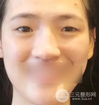 上海華美雙眼皮案例