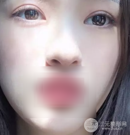 上海華美雙眼皮案例