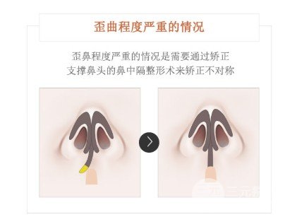 矯正歪鼻的方法