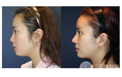 鼻尖整形需要多少錢