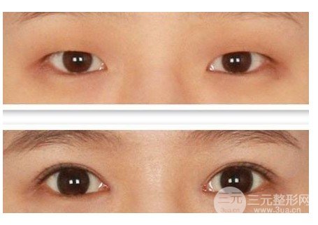 開(kāi)大眼角手術(shù)果對(duì)比圖