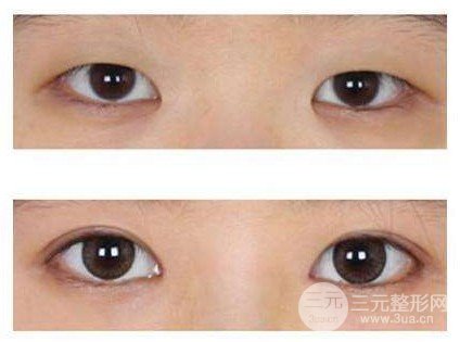 開(kāi)大眼角手術(shù)果對(duì)比圖