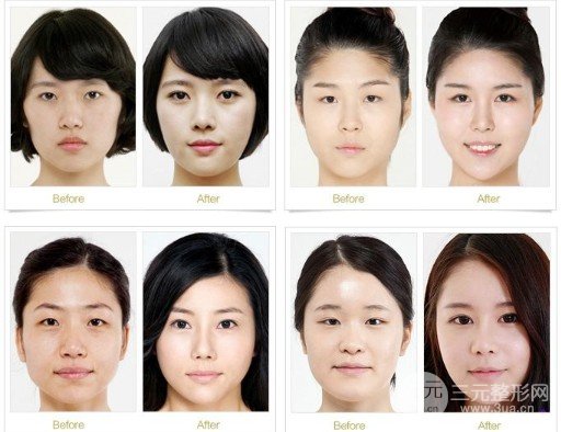 開(kāi)大眼角手術(shù)果對(duì)比圖