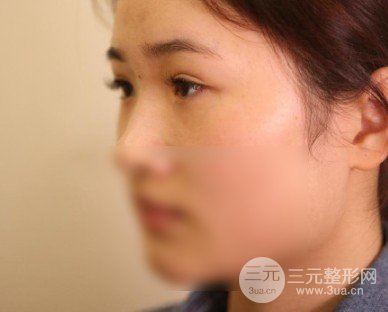 開眼角前后對(duì)比照片