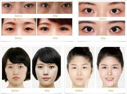 開眼角前后對(duì)比照片