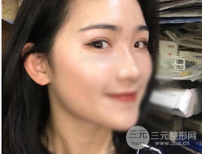 開眼角前后對(duì)比照片