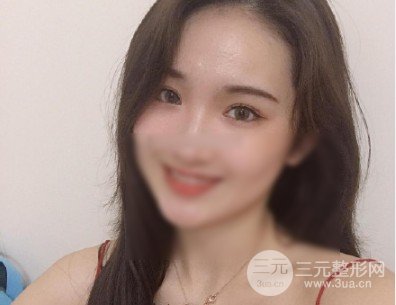 開眼角前后對(duì)比照片