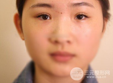 開眼角前后對(duì)比照片