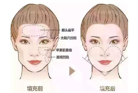 做填充以后注意事項(xiàng)