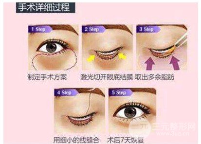 抽脂去眼袋手術(shù)的利弊