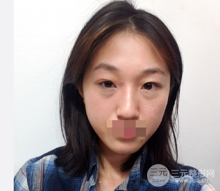 抽脂去眼袋手術(shù)的利弊