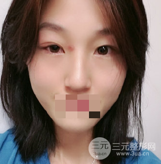 抽脂去眼袋手術(shù)的利弊