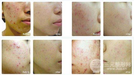 復(fù)合彩光嫩膚的作用