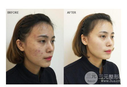 復(fù)合彩光嫩膚的作用