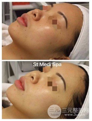 復(fù)合彩光嫩膚的作用