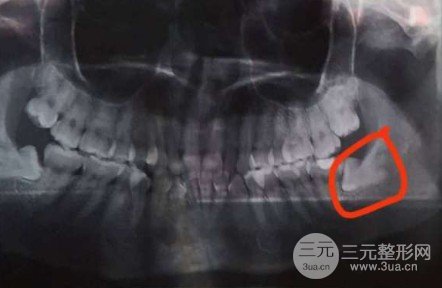 福建醫(yī)科大學(xué)附屬口腔醫(yī)院拔智齒掛啥科