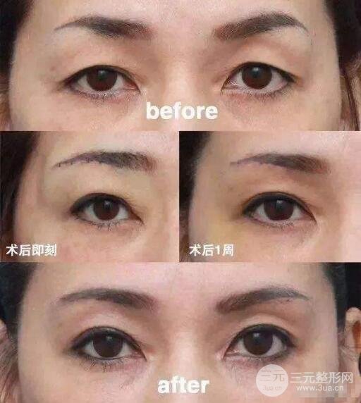 提眉術前后對比照片