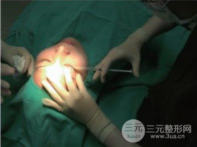 雙眼皮全切過程