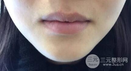 M唇手術(shù)對比照：