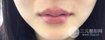 M唇手術(shù)對比照：