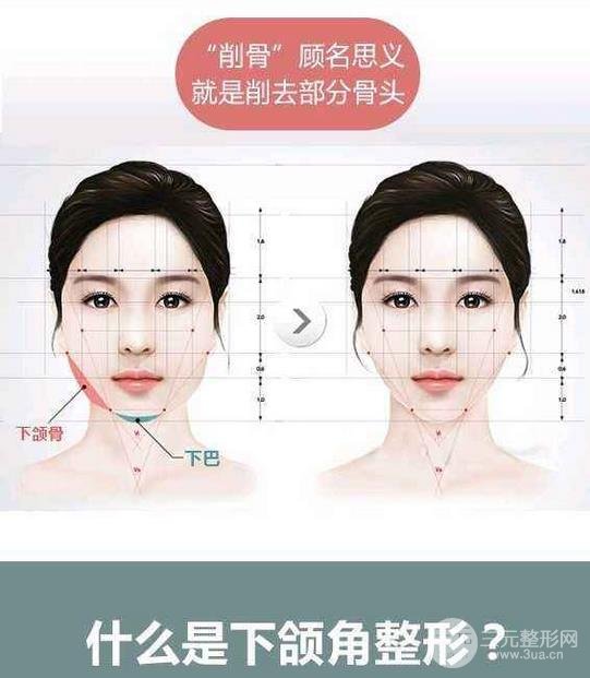 國字臉削骨價格一般多少錢？手術注意事項以及案例圖分享~