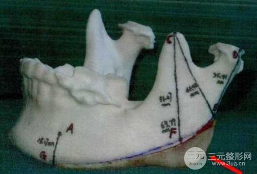 國字臉削骨價格一般多少錢？手術注意事項以及案例圖分享~