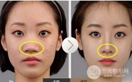 鼻頭鼻翼縮小手術(shù)風(fēng)險(xiǎn)