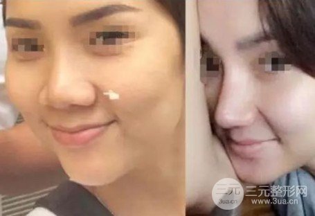 鼻頭鼻翼縮小手術(shù)風(fēng)險(xiǎn)