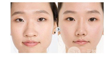 鼻頭鼻翼縮小手術(shù)風(fēng)險(xiǎn)