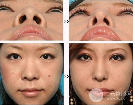 鼻頭鼻翼縮小手術(shù)風(fēng)險(xiǎn)