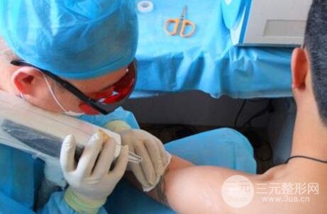 洗掉紋身的費(fèi)用?