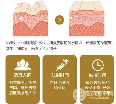 玻尿酸填充鼻唇溝成好嗎