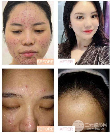 激光去痘印價格多少