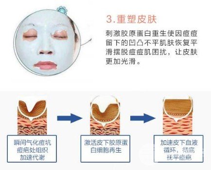 激光去痘印價格多少