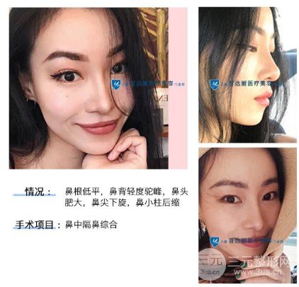 自體軟骨隆鼻的價(jià)格貴嗎