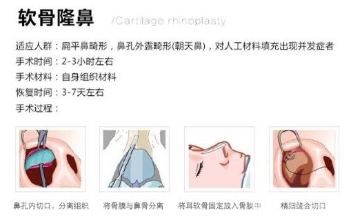 自體軟骨隆鼻的價(jià)格貴嗎