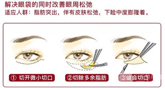 吸脂去眼袋多久能恢復(fù)