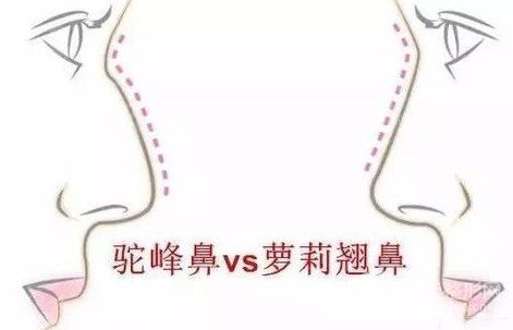 駝峰鼻整形費(fèi)用貴嗎