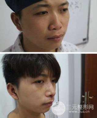 駝峰鼻整形費(fèi)用貴嗎