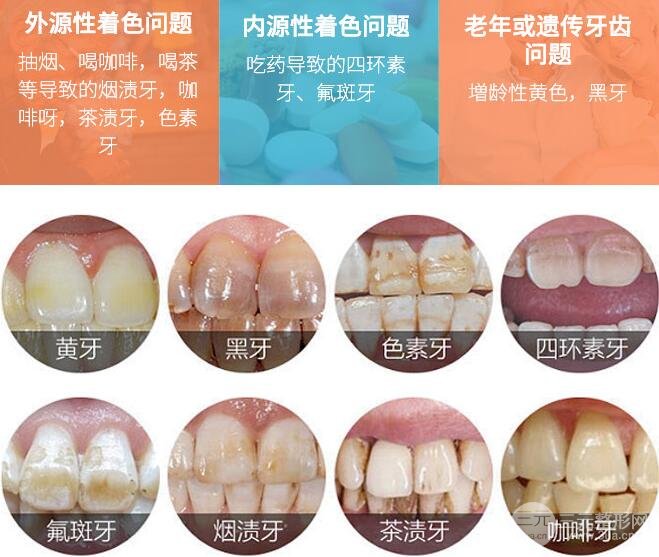 北大口腔醫(yī)院講解牙齒美白