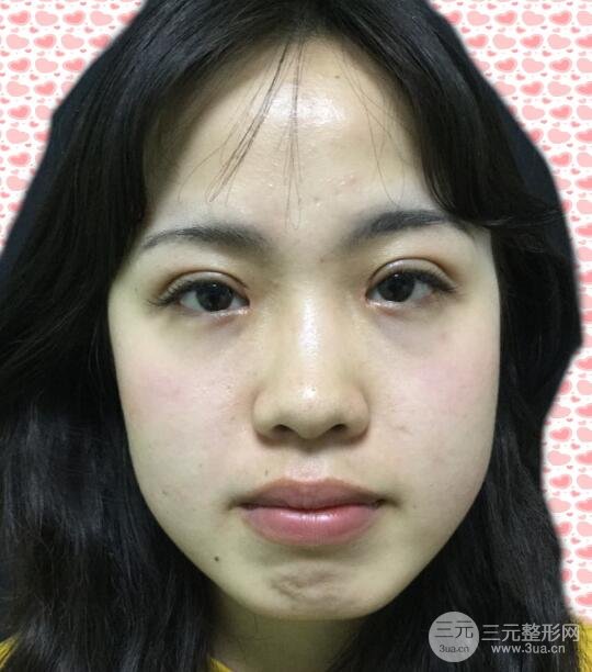 耳軟骨墊鼻尖失敗照片|鼻修復經(jīng)歷，鼻子第二次重生~