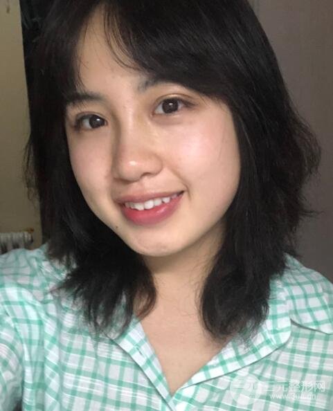 耳軟骨墊鼻尖失敗手術(shù)時