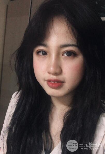 耳軟骨墊鼻尖失敗手術(shù)后