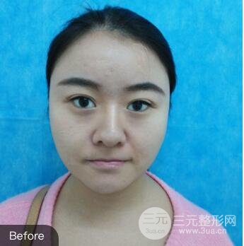 單眼皮整容前