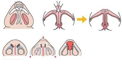 隆鼻后皮膚會(huì)變松嗎?