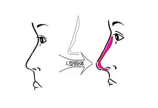 隆鼻假體壽命有多長(zhǎng)