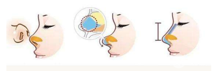 鼻頭塑形是什么項(xiàng)目