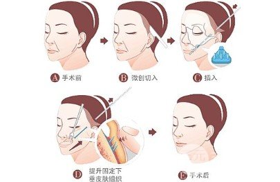 怎么樣去法令紋