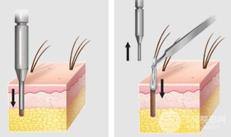 廣西南寧植發(fā)醫(yī)院案例